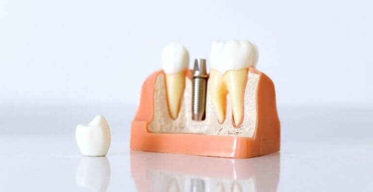 Implantes Dentários em Viseu e Fornos de Algodres