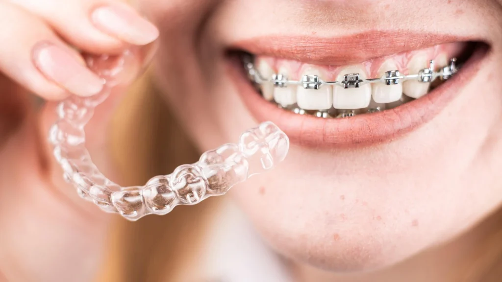 Aparelho fixo metálico colocado nos dentes superiores, visto de perto num sorriso