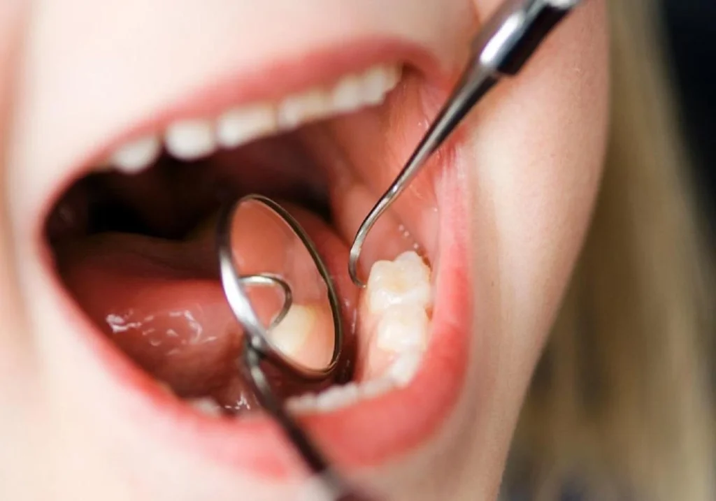 Observação da zona posterior da boca com espelho dentário, onde nascem os dentes do siso