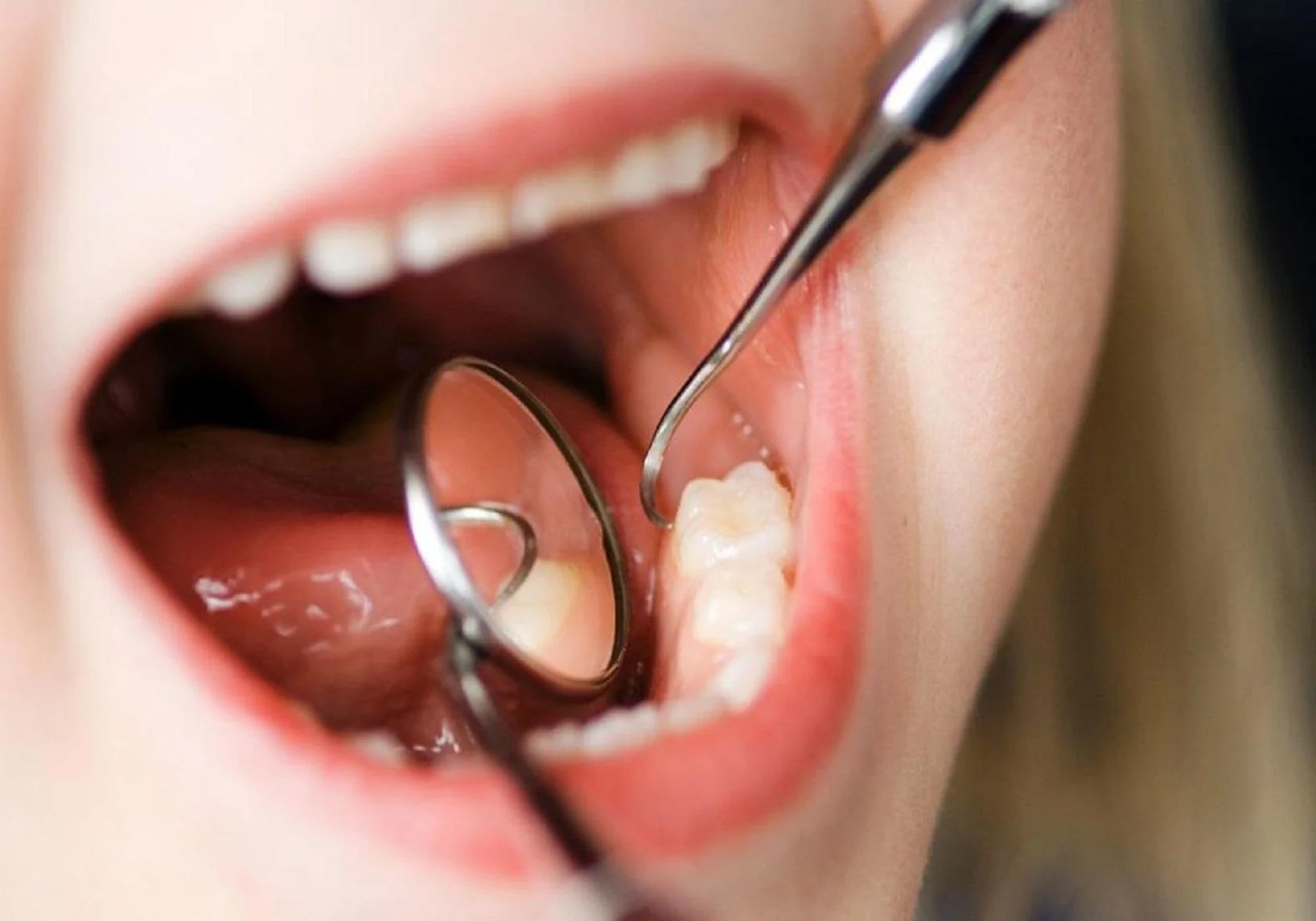 Observação da zona posterior da boca com espelho dentário, onde nascem os dentes do siso
